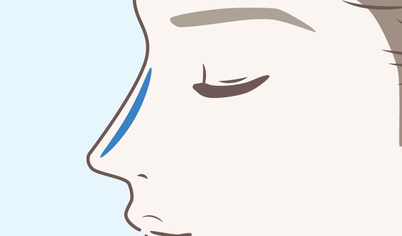 プロテーゼ（医療用シリコン）を鼻筋に挿入する